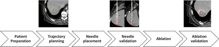IntechOpen workflow figure for stereotactic image-guided liver tumor ablation