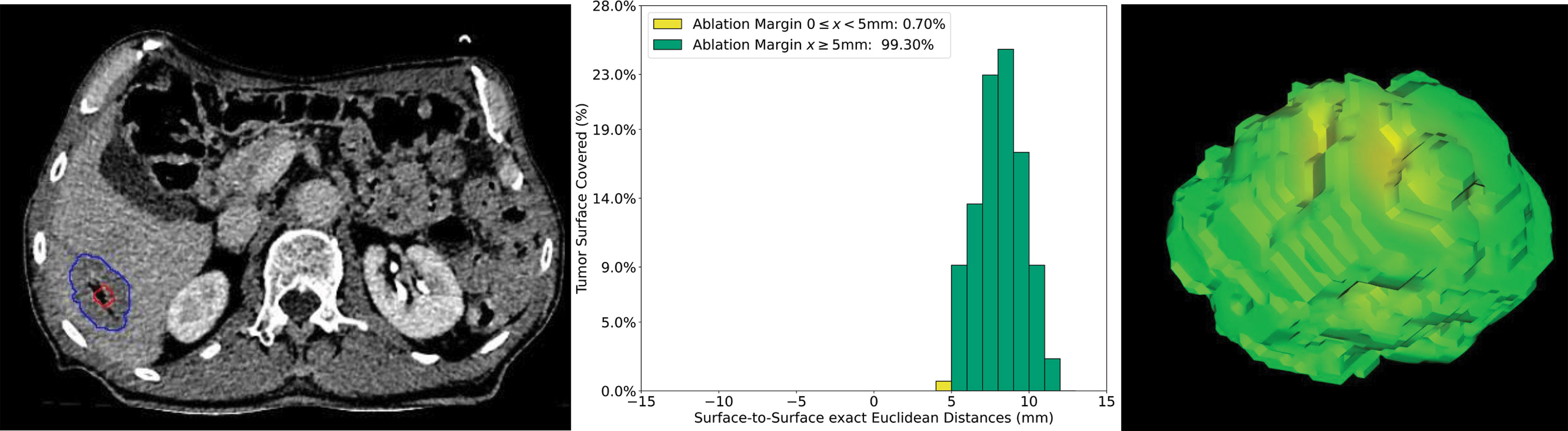CT image, histogram, and 3D quantitative ablation margin visualization from the QAM article